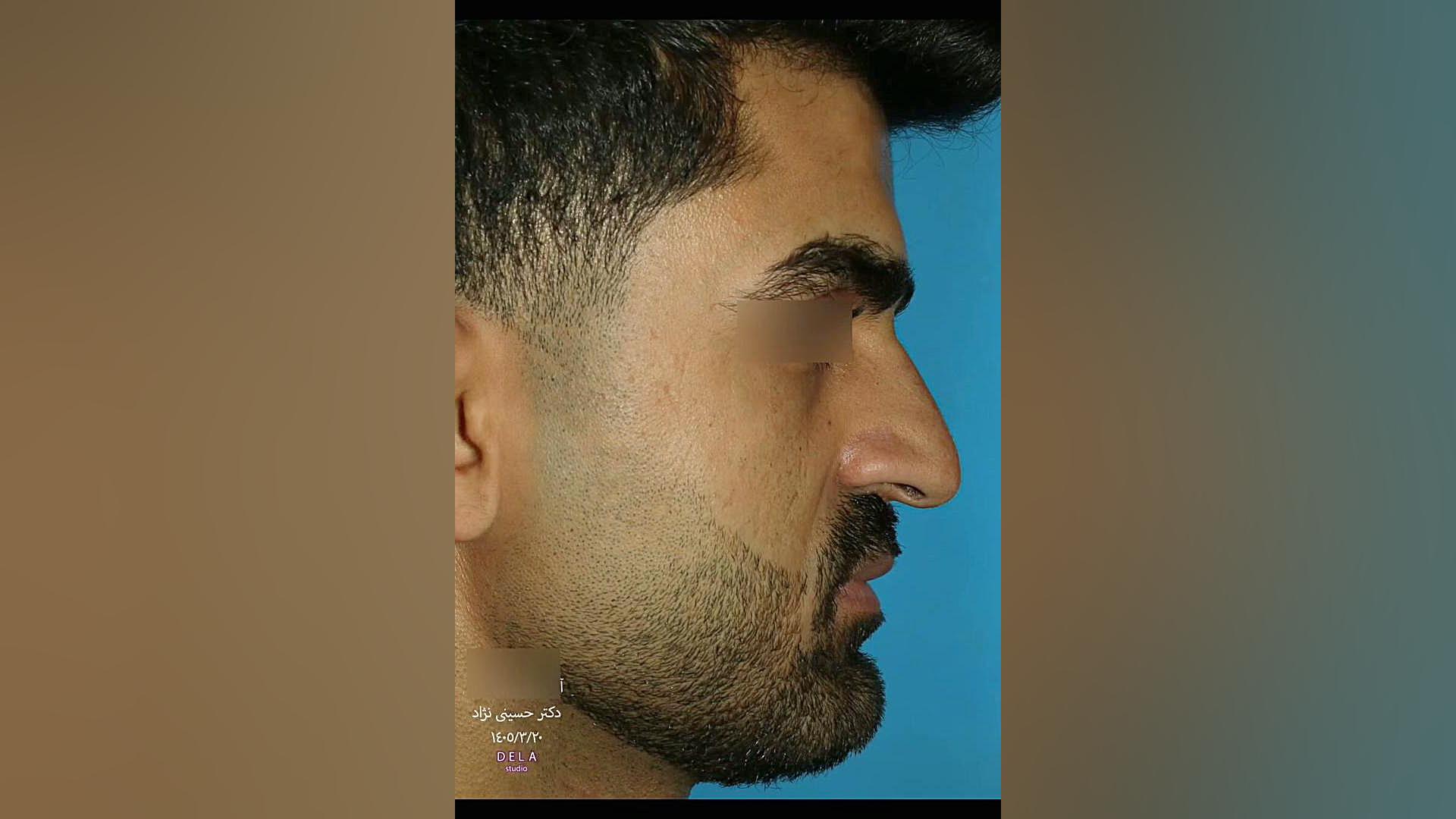 عمل بینی مردانه | دکتر صاحب حسینی نژاد