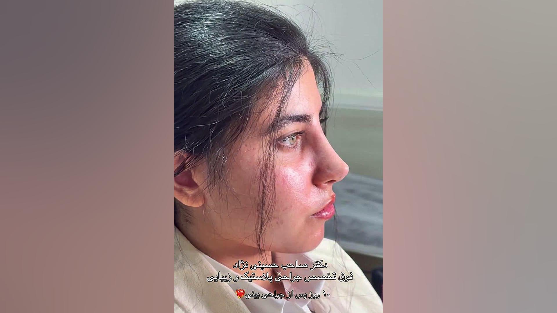 ده روز بعد از رینوپلاستی | دکتر صاحب حسینی نژاد
