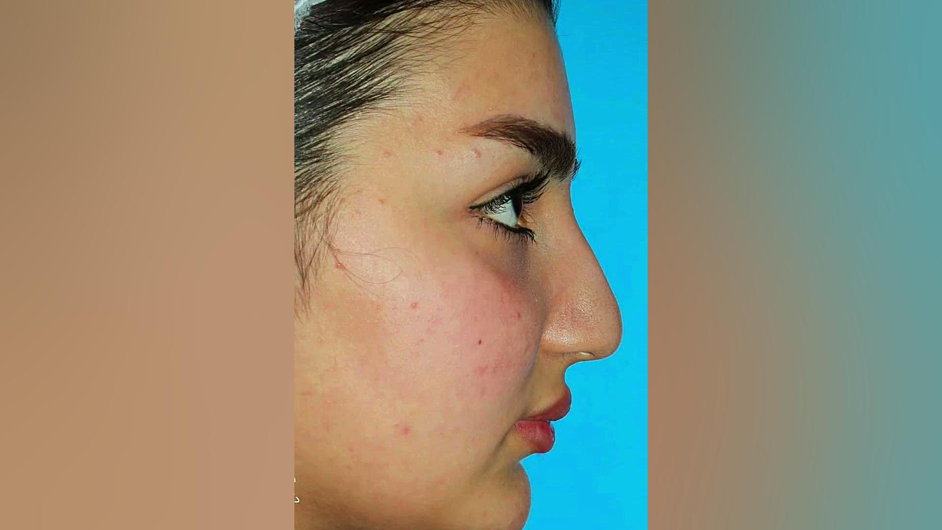 نتیجه عمل بینی | دکتر حسینی نژاد
