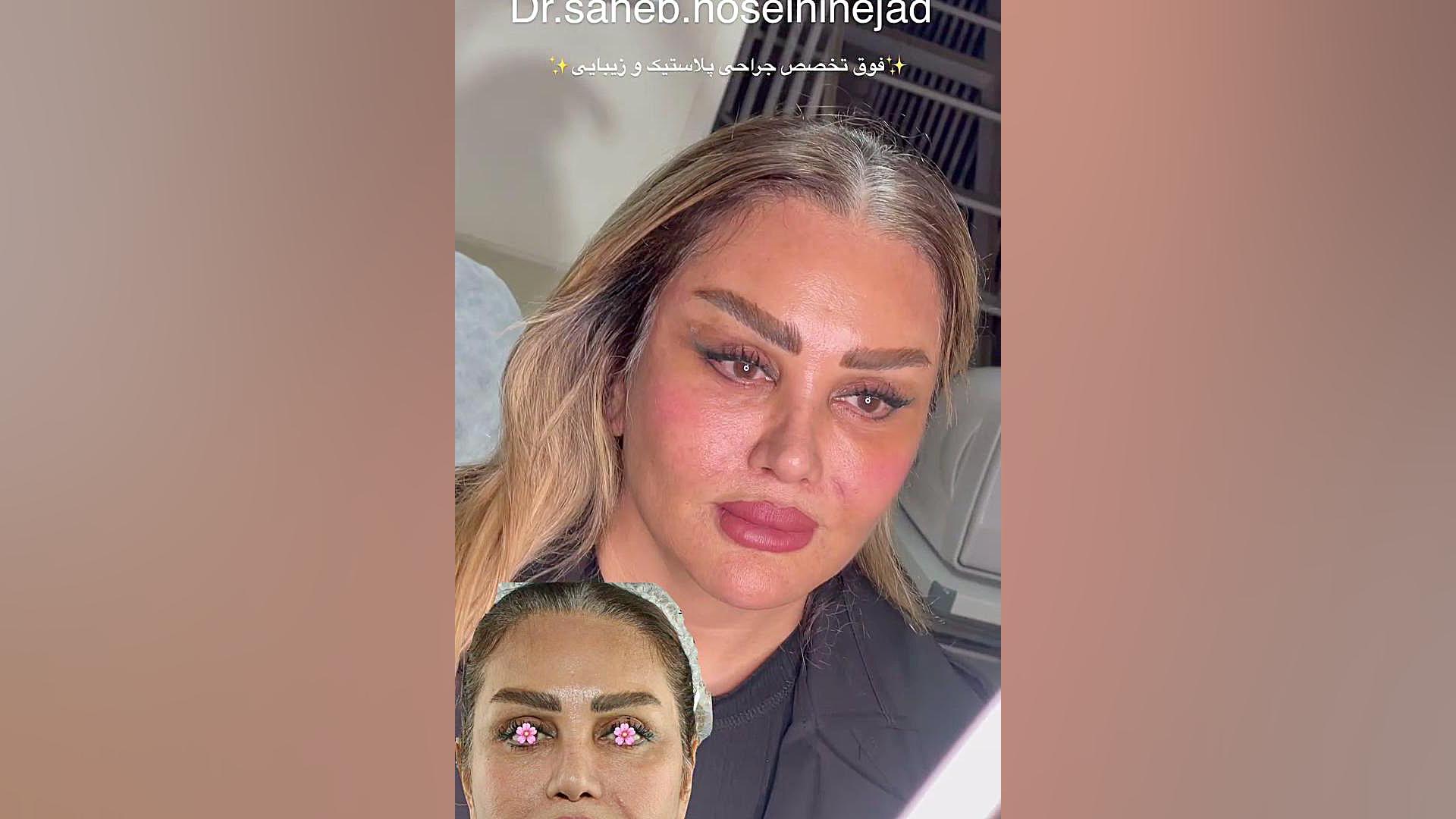 نتیجه لیفت صورت،  پیشانی ، ابرو ، شقیقه و گونه‌ها | دکتر صاحب حسینی نژاد
