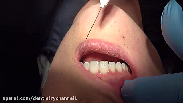 تزریق بیحسی برای دبریدمان ریشه دندانپزشک زیبایی