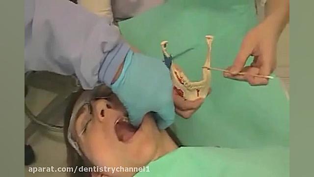 بلوک عصب آلوئولار تحتانی اکستنشن تاج دندان