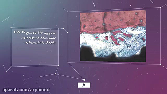 ایمپلنت در محل بدون استخوان ! ژنراتور پالس عصبی