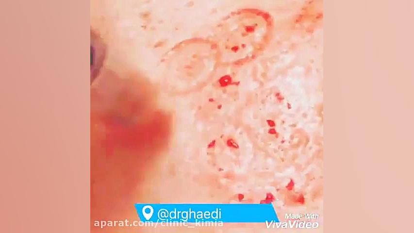 مزوتراپی خشک و پی آر پی علامت برودزینسکی