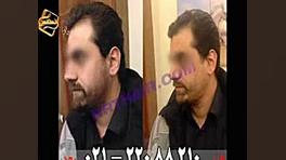 کاشت ریش و سبیل به روش SUT مرکز مو رنسانس اصلاح طرح لبخند
