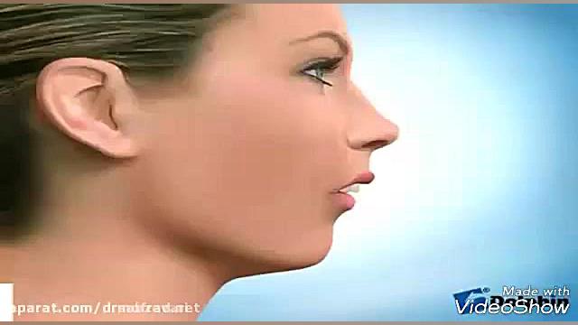 جراحی فک کولفی‌تیل