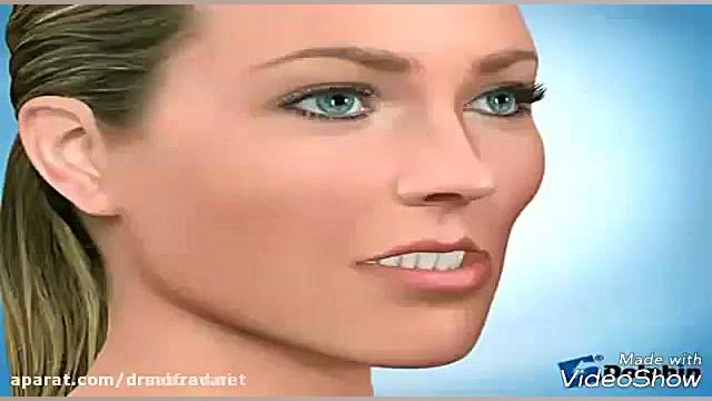 جراحی فک بالا دکتر علیرضا مفرد