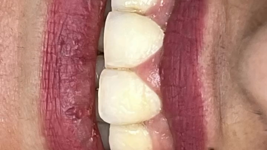 جراحی افزایش طول تاج دندان  | دکتر ستاره هاشمی