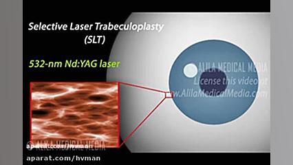 کلینیک چشم پزشکی شمس درمان لیزری آب سیاه جراحی زیبایی پلک