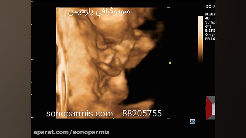 سونوگرافی سه بعدی جانی دپ