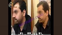 کاشت ریش و سبیل به روش SUT مرکز مو رنسانس HIDA Scan