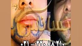 کاشت ریش و سبیل - کاشت مو و ترمیم مو رنسانس لیپوماتیک