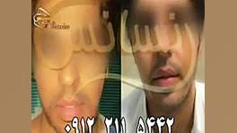 کاشت ریش و سبیل - کاشت مو و ترمیم مو رنسانس میلوشل