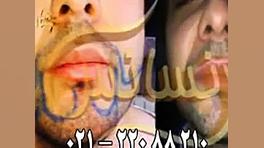 کاشت ریش و سبیل - کاشت مو و ترمیم مو رنسانس هولوگرام سه‌بعدی جراحی