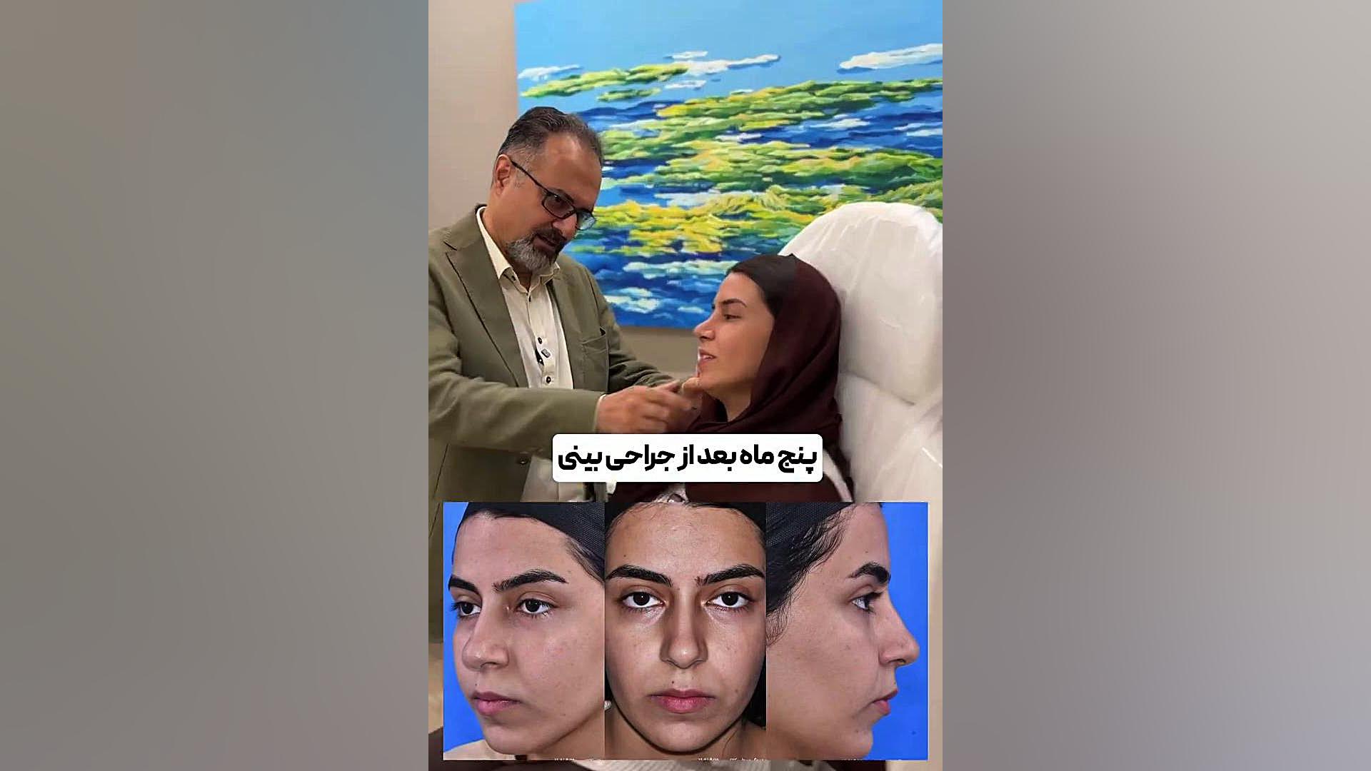 عمل بینی بعد از 5 ماه | دکتر یزدانی