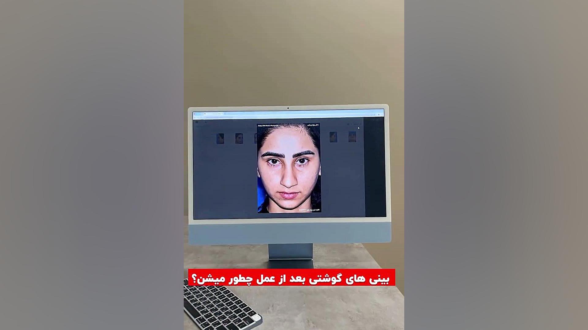 قبل و بعد از عمل بینی گوشتی | دکتر یزدانی