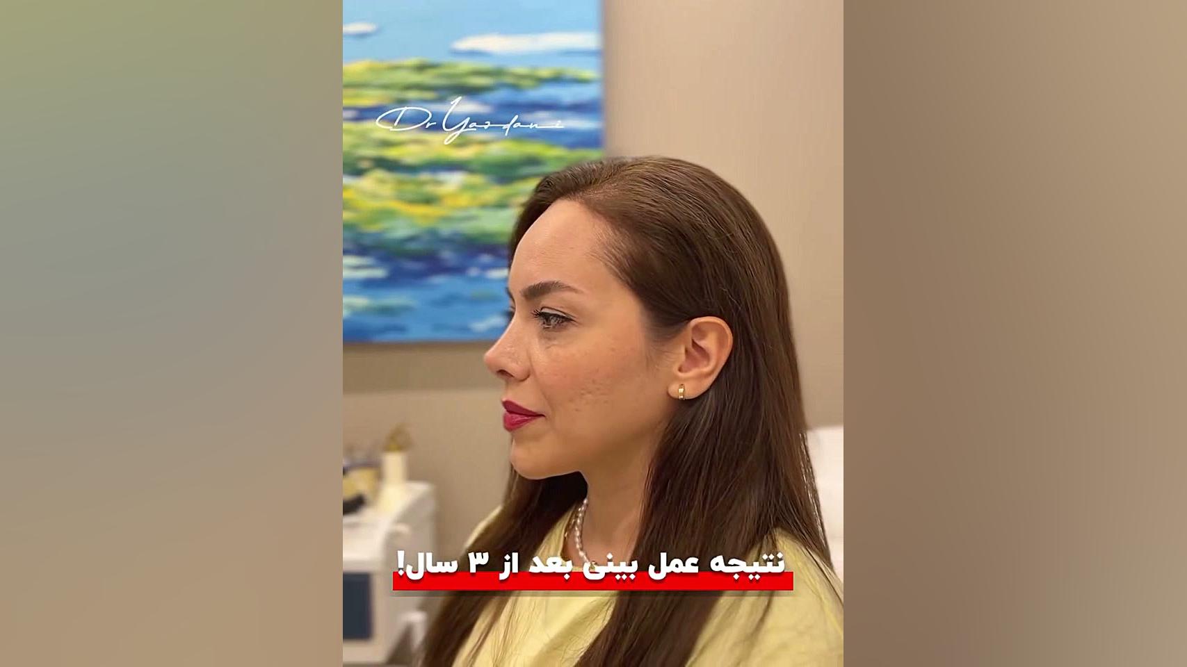 نتیجه عمل بینی بعد از 3 سال | دکتر یزدانی