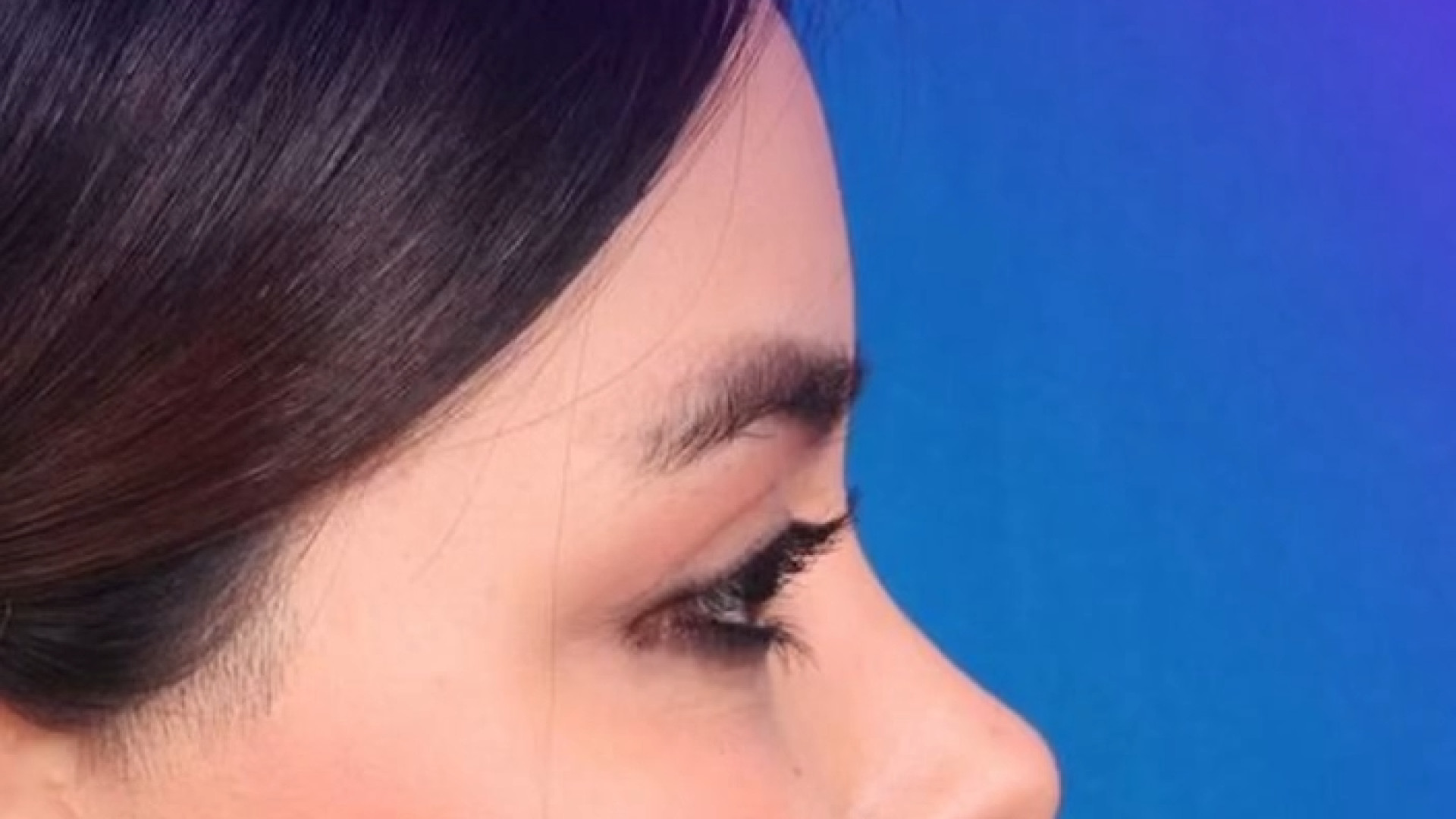 عمل بینی گوشتی با فرم نیمه‌ فانتزی | دکتر زرین قلم