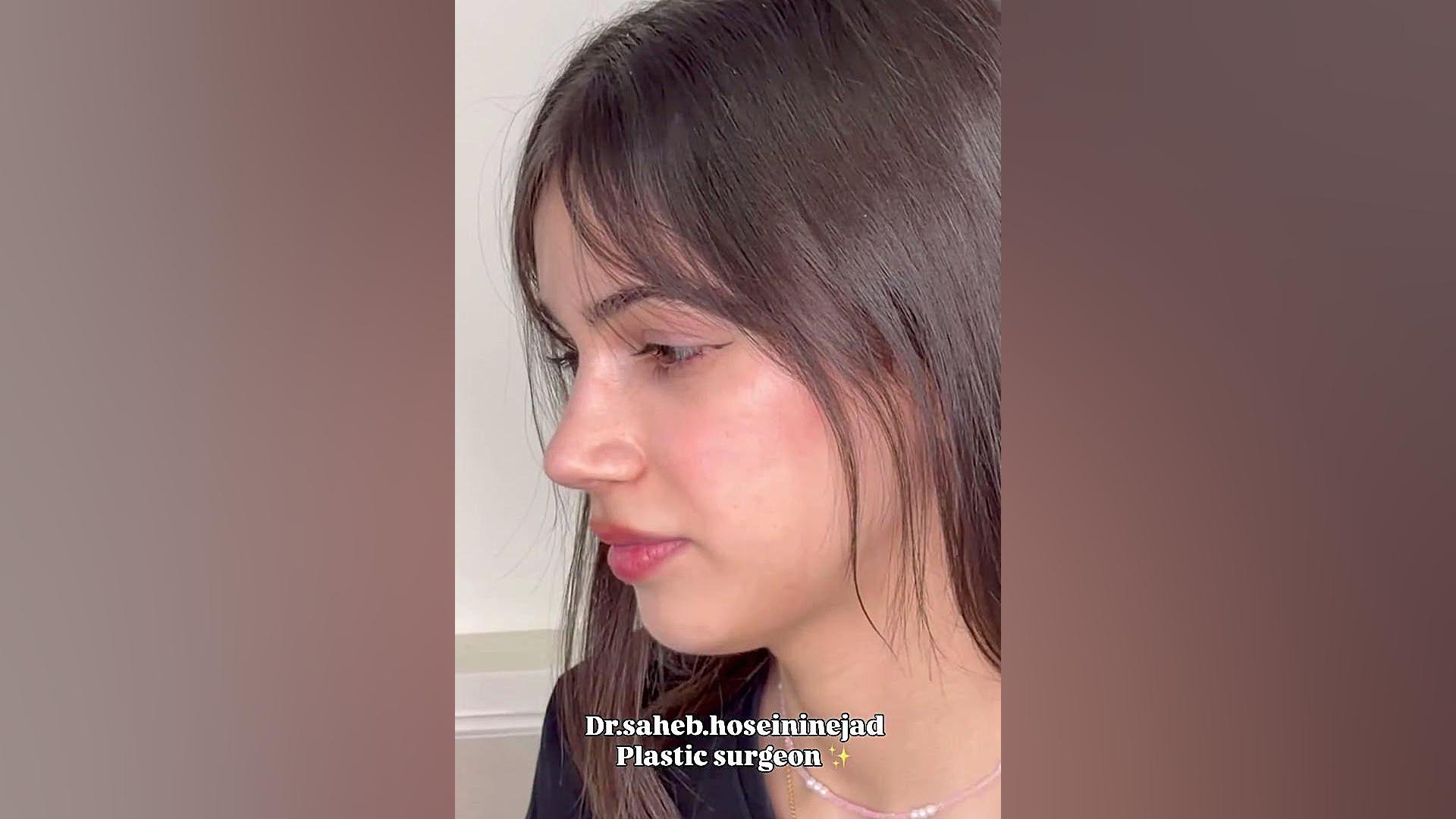 جراحی بینی طبیعی | دکتر صاحب حسینی نژاد