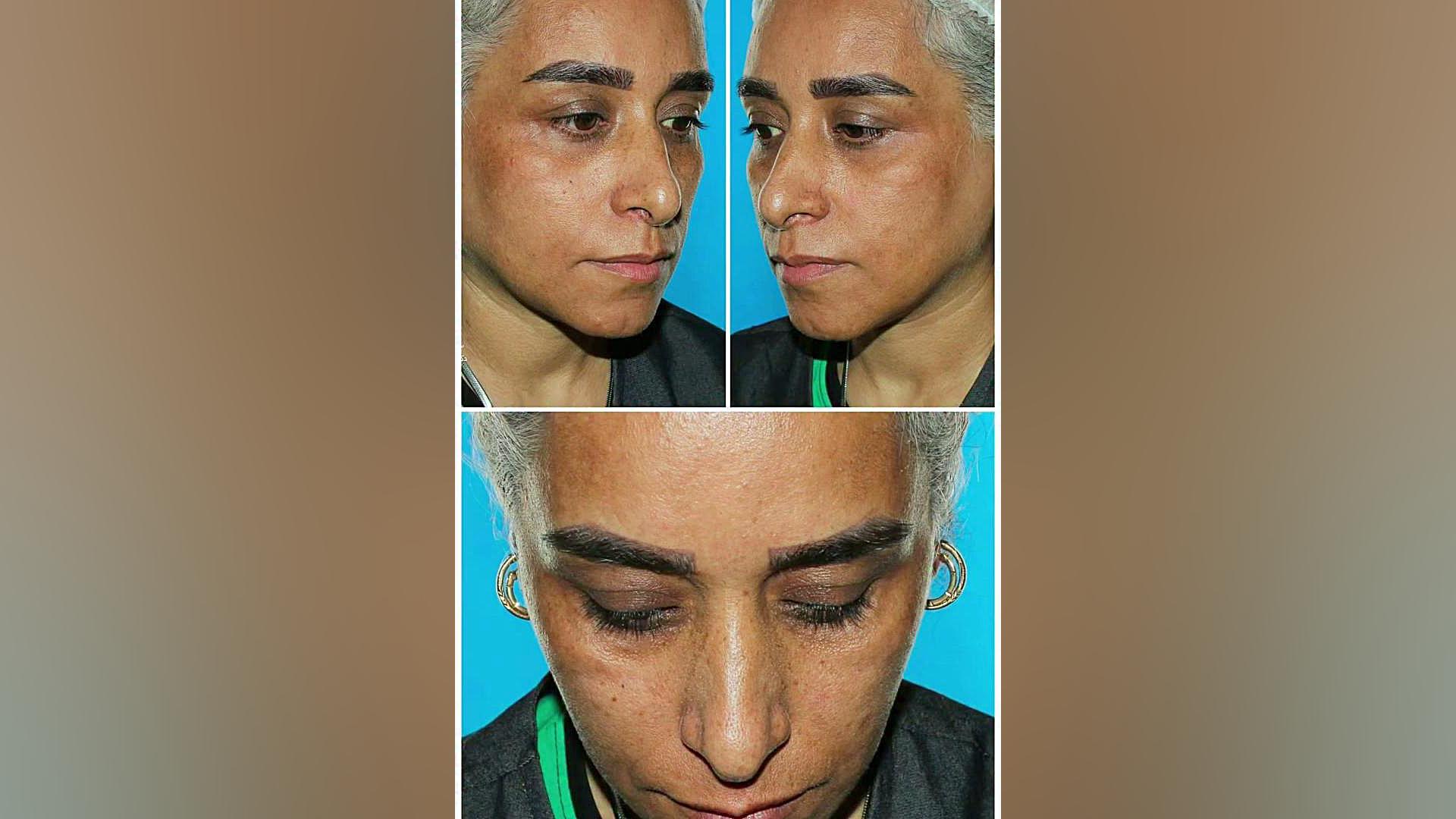 ۶ ماه پس از جراحی ترکیبی صورت | دکتر حسینی نژاد
