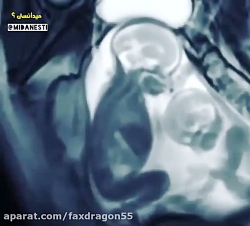 دعوای جنین های دو قلو، داخل کی...