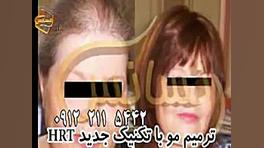 ترمیم مو به روش HRT مرکز تخصصی مو رنسانس برداشتن زگیل