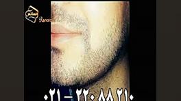 کاشت ریش و سبیل - کاشت مو و ترمیم مو رنسانس دیسمورفی فاسیال