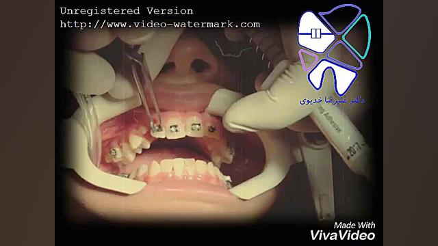 مراحل انجام ارتودنسی دکتر علیرضا خدیوی