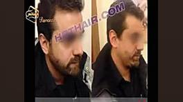 کاشت ریش و سبیل - کاشت مو و ترمیم مو رنسانس بیورآکتور سه‌بعدی