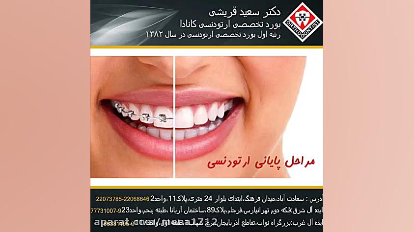 مراحل پایانی ارتودنسی (دی-باند) دکتر سعید قریشی