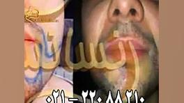 کاشت ریش و سبیل - کاشت مو و ترمیم مو رنسانس کربوکسی تراپی