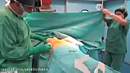 جراحی ماموپلاستی پزشکی میکروRNA