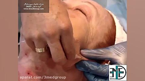 کربوکسی تراپی رادیوگرافی دندان