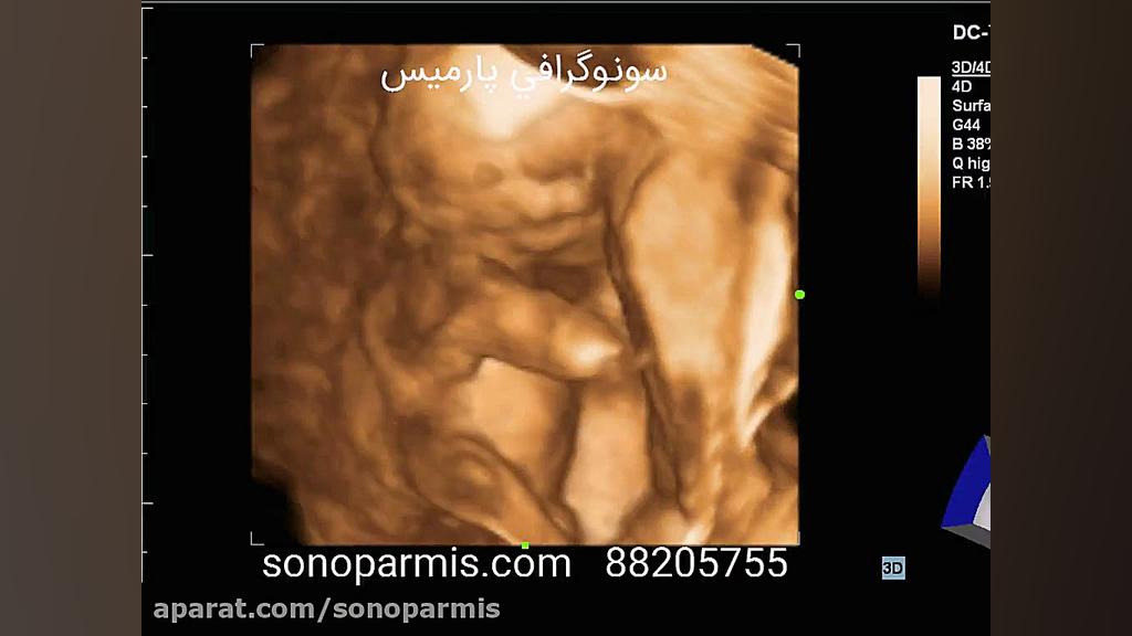 سونوگرافی سه بعدی لیلا بلوکات