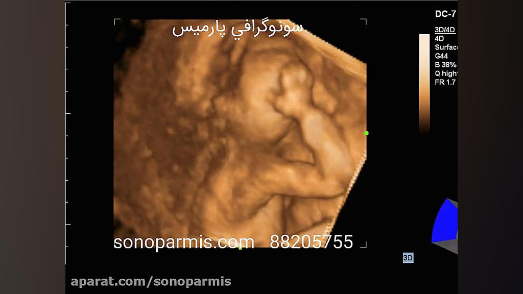 سونوگرافی سه بعدی جنین دماغ آلبالویی