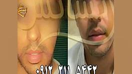 کاشت ریش و سبیل - کاشت مو و ترمیم مو رنسانس پلتفرم مدلسازی بیماری in vitro