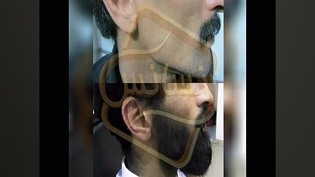 کاشت ریش و سبیل - کاشت مو و ترمیم مو رنسانس تزریق بوتاکس