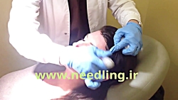 جوانسازی صورت با میکرونیدلینگ