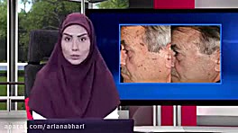 از بین رفتن کک و مک و لک صورت فقط در ۷۲ ساعت اینسایزینگ