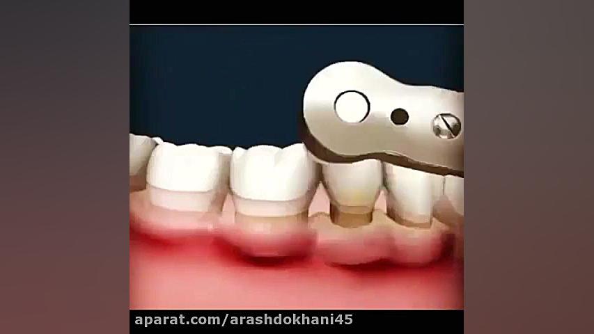 اثرات مثبت و مفید جرمگیری و بروساژ دکتر آرش دخانی