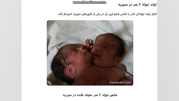 تولد نوزاد دو سر لیپوماتیک