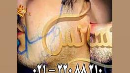کاشت ریش و سبیل به روش SUT مرکز مو رنسانس بیماری سندروم نوتان