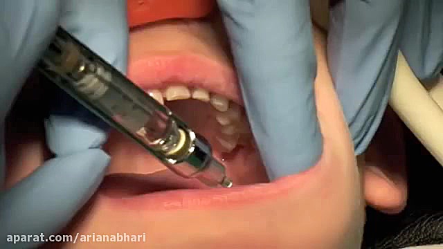 بایدها و نبایدهای تزریق آمپول بی حسی آر اف فرکشنال