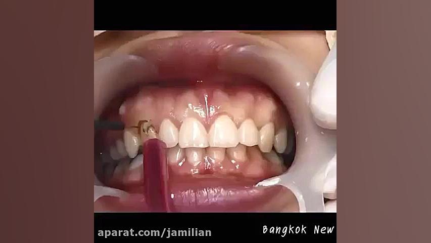 افزایش طول تاج کلینیکی دکتر عبدالرضا جمیلیان - متخصص ارتودنسی