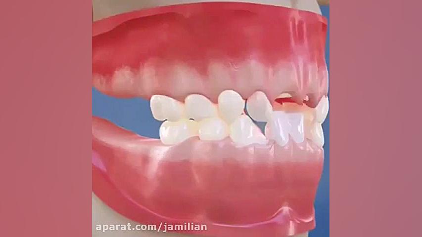 نحوه قرار دادن براکت یا باندینگ در ارتودنسی دکتر عبدالرضا جمیلیان - متخصص ارتودنسی