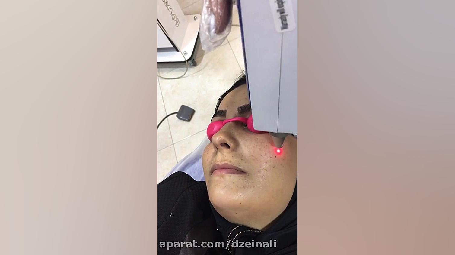 رفع كك ومك صورت با لیزر پیشرفته كیوسوایچ دکتر فرحناز زینعلی - متخصص پوست، مو، زیبایی زنجان