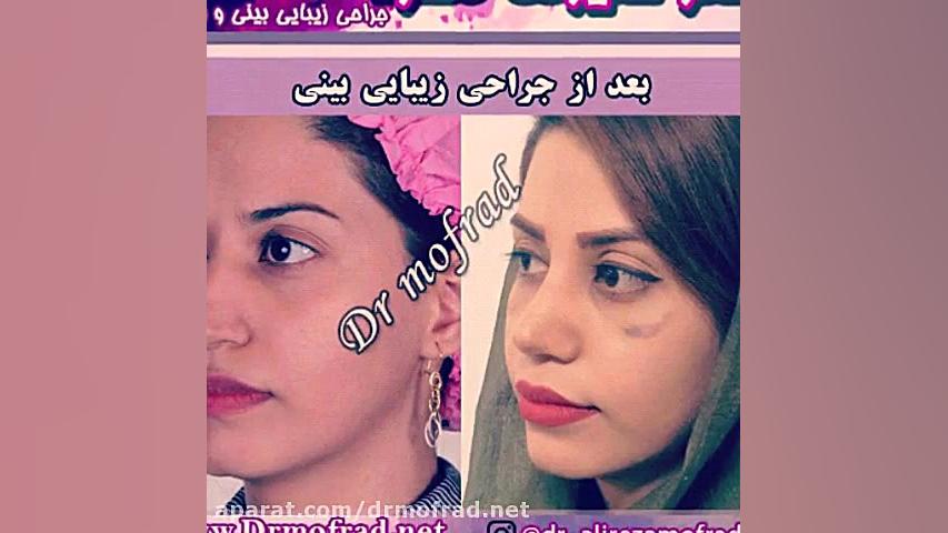 نمونه های جراحی بینی دکتر علیرضا مفرد