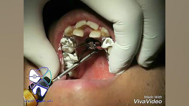 مراحل نصب پیچ هایرکس با اسکرو دکتر علیرضا خدیوی