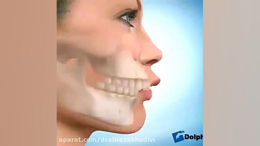 كاهش برجستگی فك بالا با كشیدن دو دندان آسیای کوچک دکتر علیرضا خدیوی