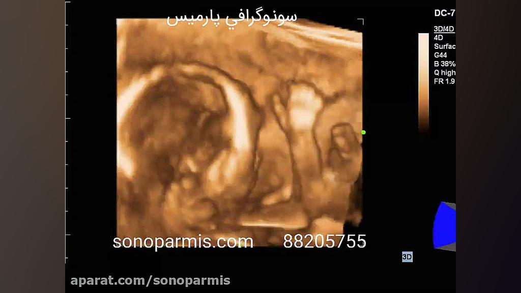 سونوگرافی سه بعدی جنین ویل اسمیت